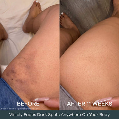 The Micro Infusion System™ For Melanin-Rich Skin