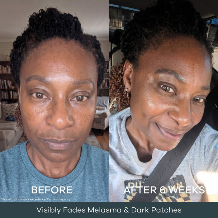 The Micro Infusion System™ For Melanin-Rich Skin