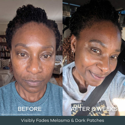 The Micro Infusion System™ For Melanin-Rich Skin